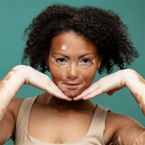their skin (and even hair) white; this symptom is connected to vitiligo - an autoimmune condition in which skin pigments are destroyed. . Vitiligo spiritual meaning